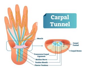 carpal tunnel hand graphic