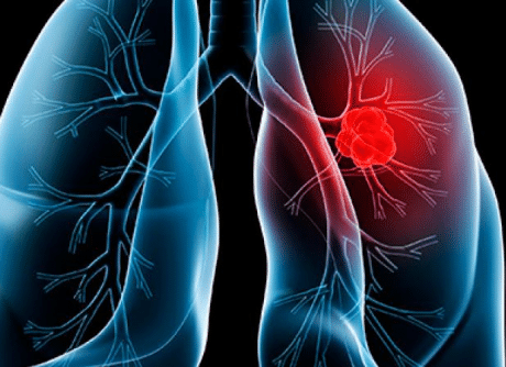 Oncology services thumbnail showing an X-ray image with a highlighted red spot indicating a tumor, used for diagnostic purposes in cancer care.